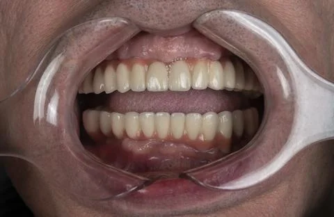 Close up of man cavity protected by retractor showing perfect teeth.implants  Stock Photos