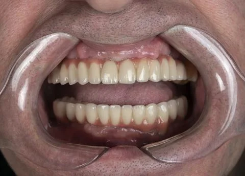 Close up of man cavity protected by retractor showing perfect teeth.implants  Stock Photos