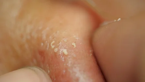 Close-up of Man crushes acne on the face. problem skin Stock-Footage 113596126