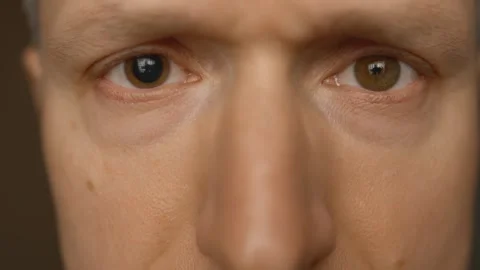 Close-up of a man face with brown eyes with one dilated big pupil. Eye drops for Stock Footage 277497216
