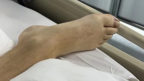 Close up of man with foot drop. Stock Photos
