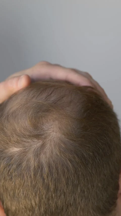Close-up of man inspecting scalp with hand, focusing on thinning crown and hair Video stock 327638519