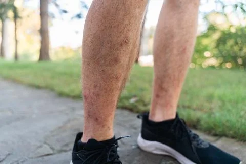 Close-up of a man leg with dermatitis scratching the blisters. Redness, itching Stock Photos