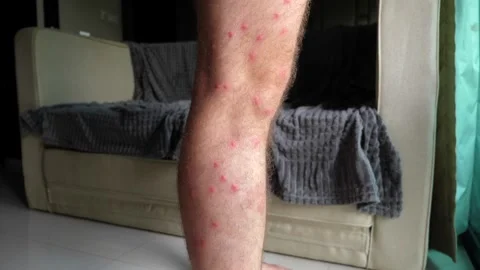 Close-up of man leg with multiple mosquito bites, showcasing need for pro Stock Footage 271199238