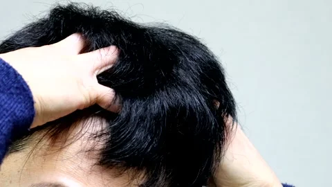 Close-up of a man massaging his scalp Stock Footage 336220193