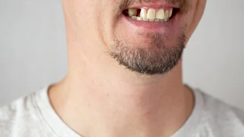 Close-up of a man mouth with missing tooth. Man after tooth extraction or t.. Stock Footage 295355598