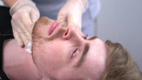 Close-up of a man preparing for beard waxing. Vidéo 149311929