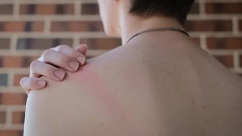 Close-up of a man with reddened skin in the neck area Stock Footage 282482170