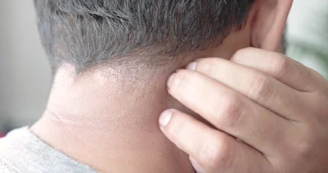 Close-up man scratches sick dry flaky skin and itching. Disease about psori.. Stock Footage 242059525