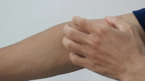 Close-up of a man scratching an intensely red, allergic Stock Footage 323724249