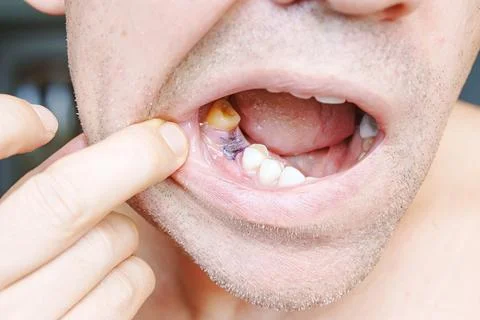 Close-up. man showing a sutured socket in the oral cavity after tooth extraction Stock Photos