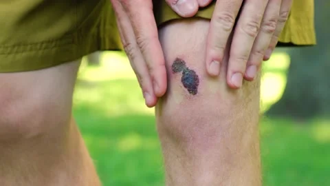 Close up man standing park touch hurt joint, suffering from bruised knee injury Stock Footage 207855264
