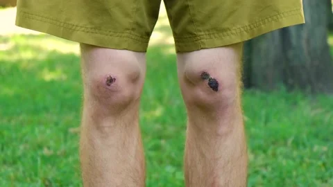 Close up man standing park touch hurt joint, suffering from bruised knee injury Vidéo 207855289