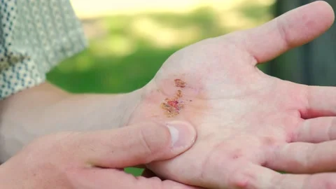 Close up man standing park touch hurt hand, suffering from bruised arm injury Stock Footage 207855357