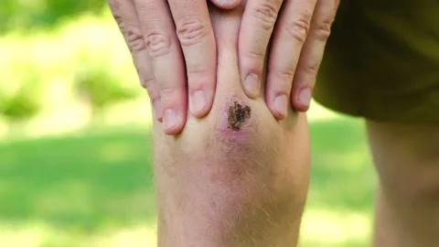Close up man standing park touch hurt joint, suffering from bruised knee injury Stock Footage 207855396