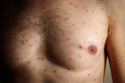 Close-up a man torso front who having varicella blisters or chickenpox or Stock Photos