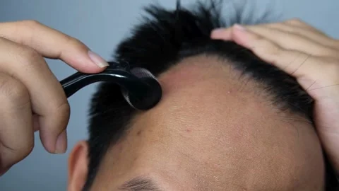 Close up of man using derma roller on scalp for hair growth Video stock 335953386