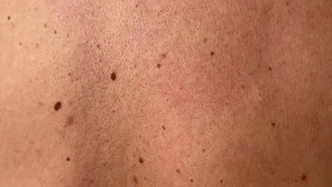 Close-up of a man's back. The back is covered with many large and small moles Stock Footage 235172291