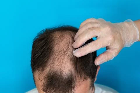 Close-up of a man's balding head being examined by a hand in medical gloves Stock Photos