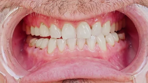 Close-up of a mans beautiful straight teeth with a retractor. Showing beautiful Stock Footage 321431036