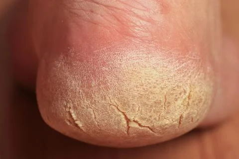 Close-up of a man's cracked heel. Stock Photos