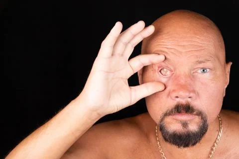 Close-up of a man's face with the consequences of glaucoma, dry eyes. Selecti Stock Photos