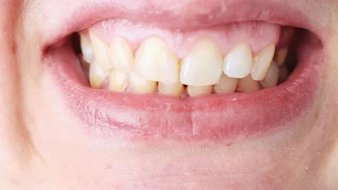Close-up of a man's face with an overbite. Problem with crooked teeth Stock Footage 170476170