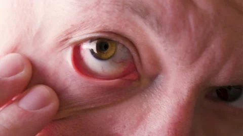Close up of man's face showing red bloodshot eye. Stock Footage 194245711