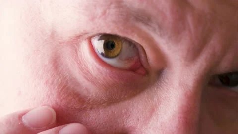 Close up of man's face showing red bloodshot eye. Stock Footage 195094365