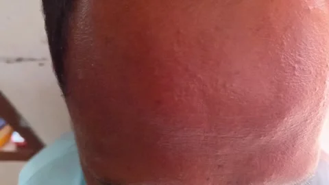 Close-up of a man's forehead and receding hairline. Stock Footage 321930050