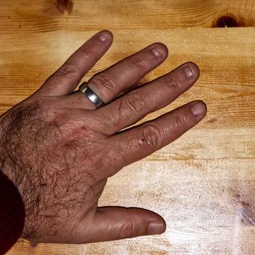 Close-up of a man's hand with obsessive compulsive onychophagy disorder Stock Photos