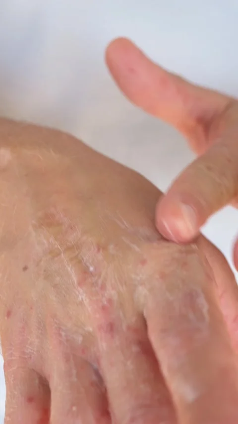 Close-up of mans hand with red rash spots as he spreads white cream slowly Stock Footage 345652194