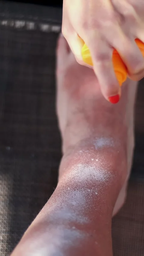 A close-up, on a man's leg with a strong sunburn, apply sunscreen, a special, Stock Footage 314112185