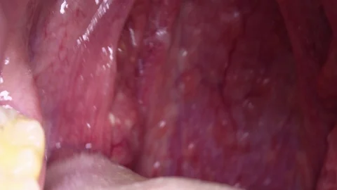 Close-up. Man's red throat. Purulent tonsillitis Stock Footage 101351953