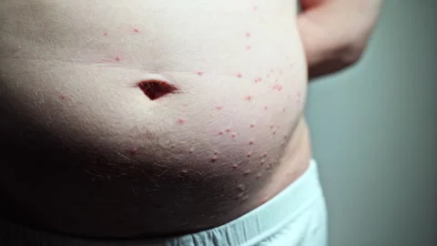 Close-up of the man's stomach with belly button, a few bumps are visible Stockbeeldmateriaal 244704627