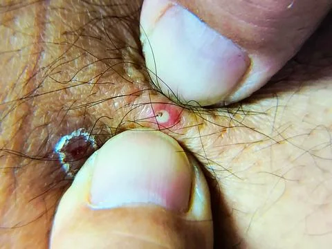 A close-up of a man's thigh with two small, red, irritated skin lesions wit.. Photos