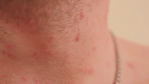 Close-up of many red rashes in chickenpo... | Stock Video | Pond5