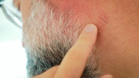Close up of mature man touching postoperative scar behind ear near gray beard Stockbeeldmateriaal 345125840