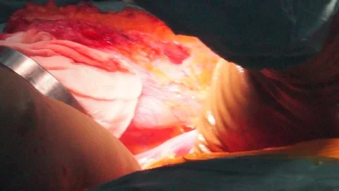 Close up of Medical Operation Stock Footage 70924294