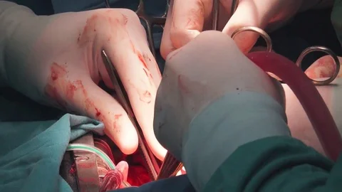 Close up of Medical Operation Stock Footage 73603049