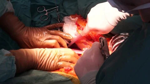 Close up of Medical Operation Stock Footage 88923161