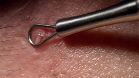 Close up of metal loop tool extracting acne blemish from human skin 스톡 동영상 337148470