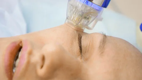 Close-up. microneedle RF lifting procedure. Hardware cosmetology. Beautician Stock Footage 117072668