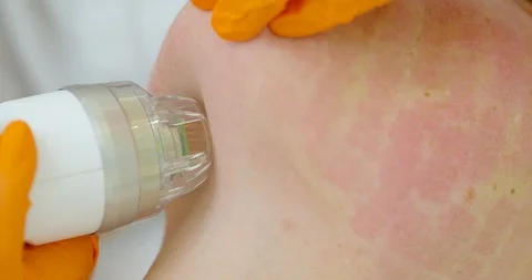 Close-up. microneedle RF lifting procedure. Hardware cosmetology. Beautician Stock Footage 120110908