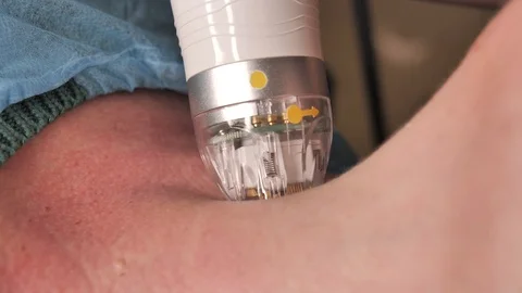 Close-up. microneedle RF lifting procedure. Hardware cosmetology. Beautician Stock-Footage 124325976