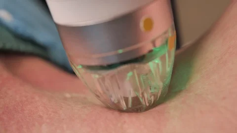 Close-up. microneedle RF lifting procedure. Hardware cosmetology. Beautician Stock Footage 124326477
