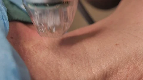 Close-up. microneedle RF lifting procedure. Hardware cosmetology. Beautician Stock Footage 124328485