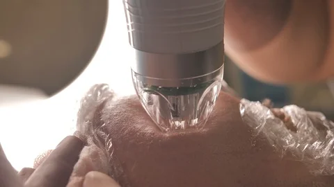 Close-up. microneedle RF lifting procedure. Hardware cosmetology. Beautician Stock Footage 124328785