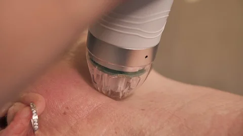 Close-up. microneedle RF lifting procedure. Hardware cosmetology. Beautician Stock Footage 124329064