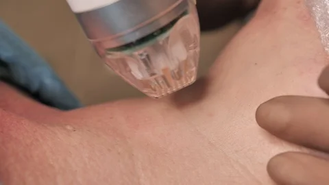 Close-up. microneedle RF lifting procedure. Hardware cosmetology. Beautician Stock Footage 124329274